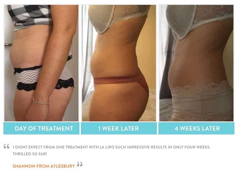 before, Cryolipolysis Henley-In-Arden