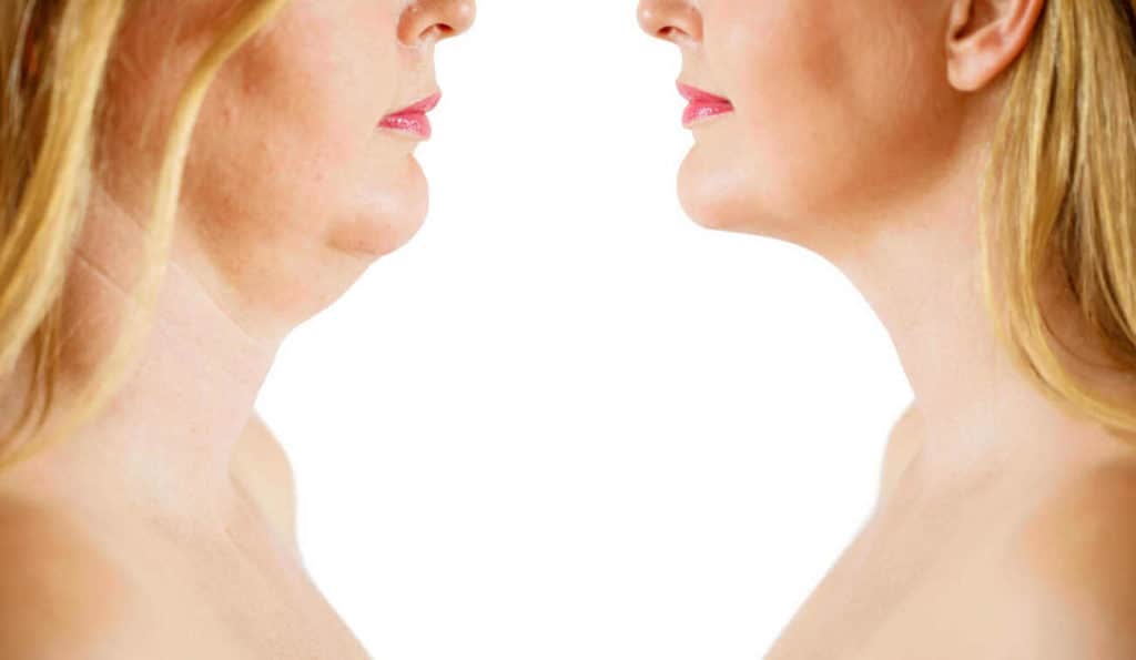 Double Chin treatment Henley-In-Arden before and after results