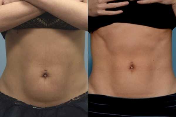 body sculpting FAQs Henley-In-Arden