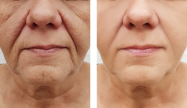 Learn more about Morpheus8 Treatment Henley-In-Arden today!