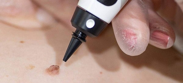 After Skin Tag Removal Henley-In-Arden