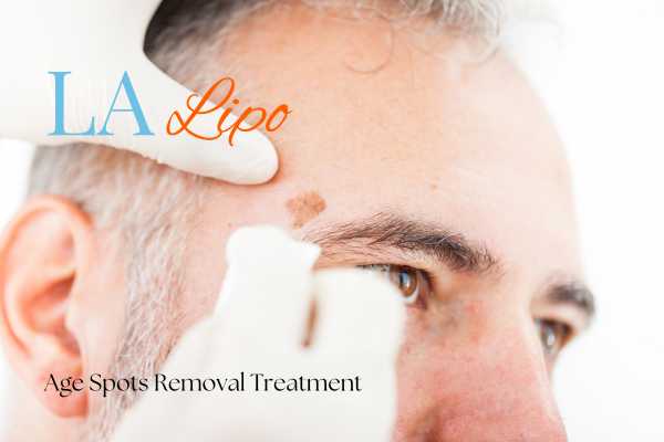 What Are the Most Effective Treatments for Age Spots Henley-In-Arden?