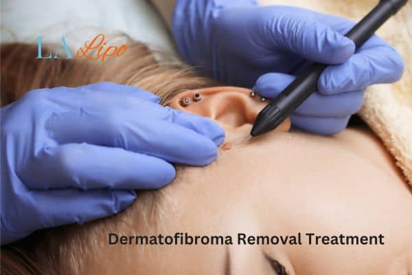 Dermatofibroma Removal Treatment Henley-In-Arden