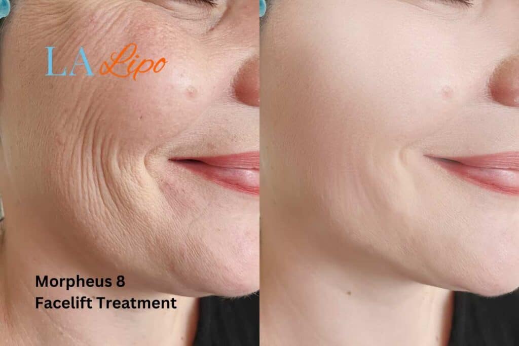 Morpheus8 Treatment Henley-In-Arden for flawless skin! Call us today!