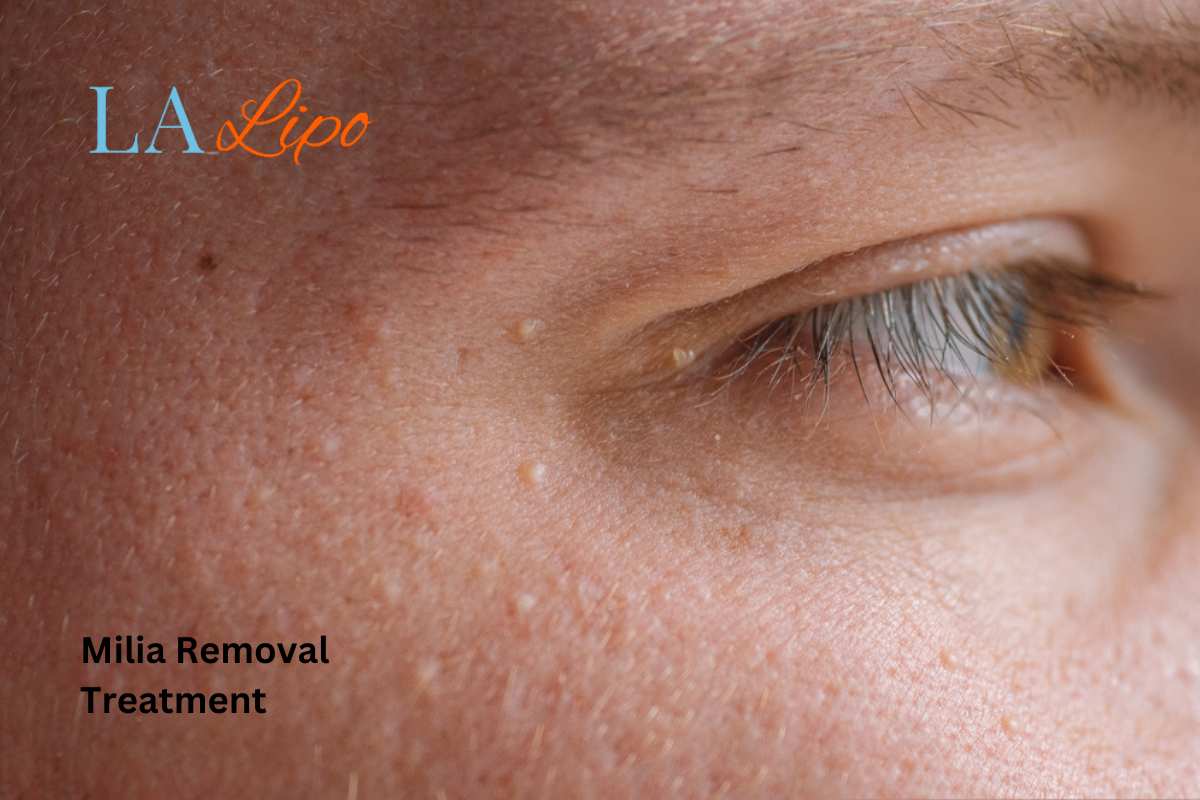 Cryopen Milia Removal: Is It the Easiest and Safest Option Henley-In-Arden?