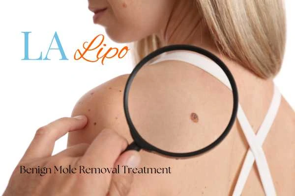 Woman having her inspection of blemish before mole removal Henley-In-Arden
