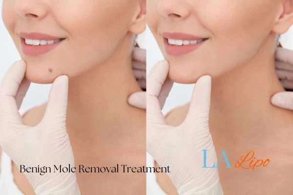 Before and after mole removal Henley-In-Arden treatment