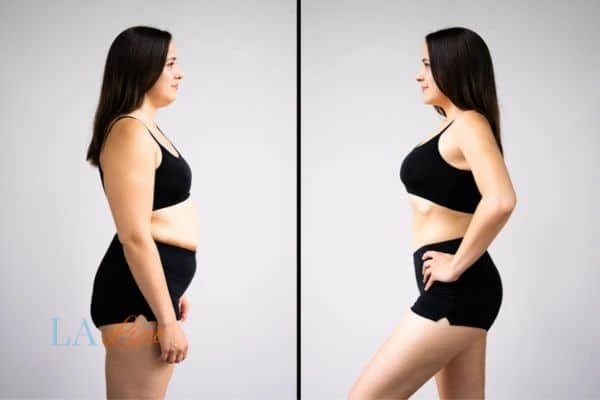 image of woman before and after results of LA-EMS Body Sculpting Henley-In-Arden to help treat Diastasis recti