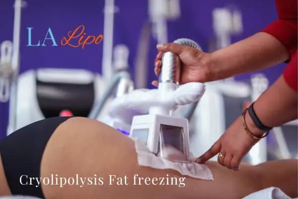 women getting fat freezing Henley-In-Arden