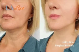 hi-fu for wrinkles Henley-In-Arden before and after results