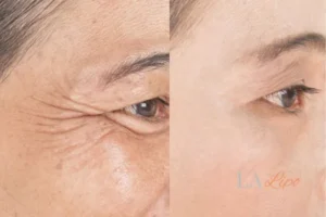 Before and after results of woman - HI-fu wrinkles reduction treatment Henley-In-Arden