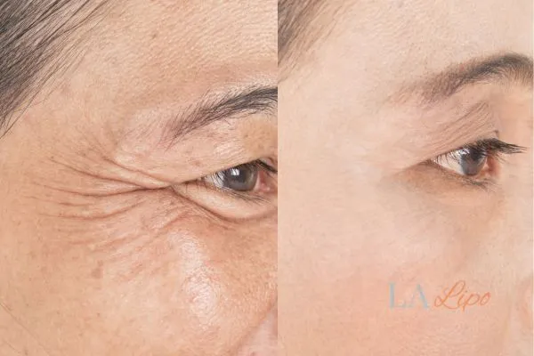 Before and after results of woman - HI-fu wrinkles reduction treatment Henley-In-Arden