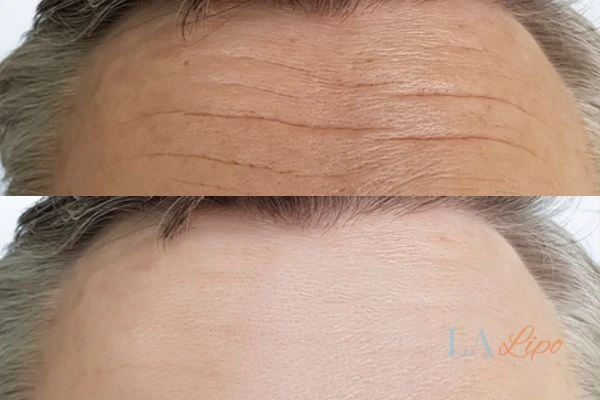 results of HIFU Henley-In-Arden on mans forehead to help reduce lines and wrinkles