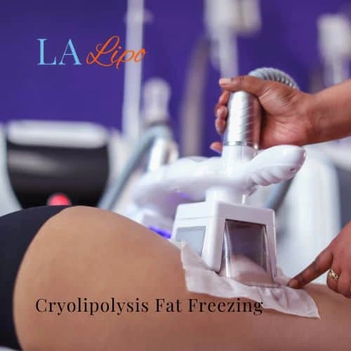 fat freezing - Cryolipolysis Henley-In-Arden