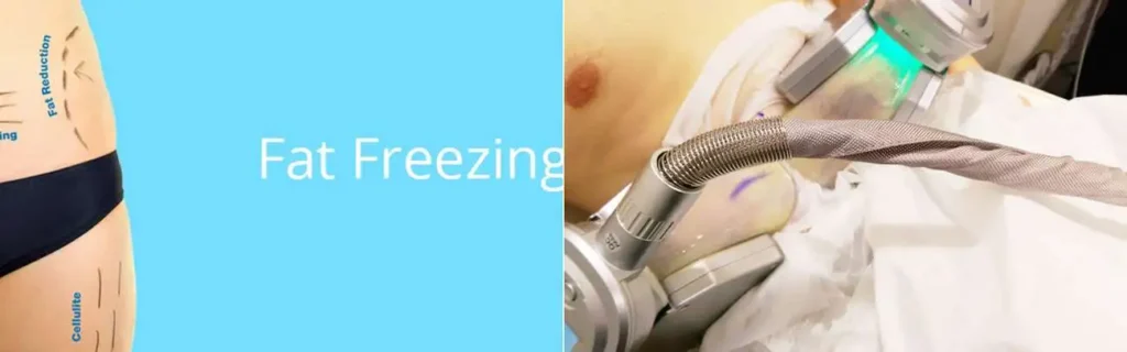 Fat freezing Henley-In-Arden on multiple areas of the body