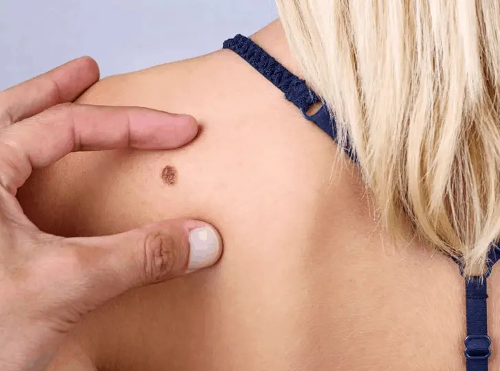 woman having mole removal Henley-In-Arden consultation before treatment.
