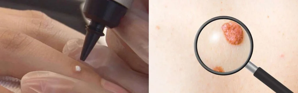 Person getting moles removed with cryopen Henley-In-Arden