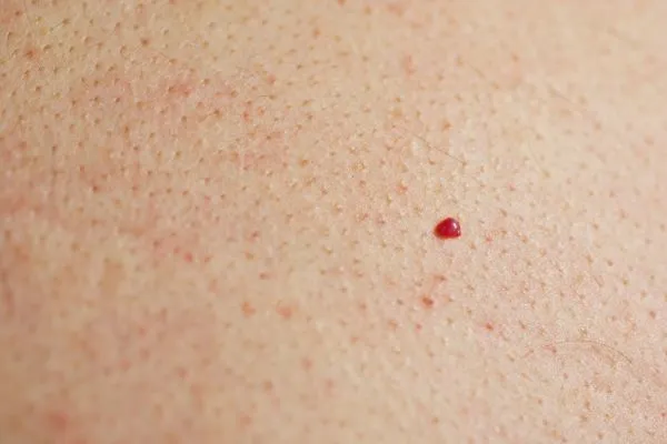 close up of a cherry angioma Henley-In-Arden