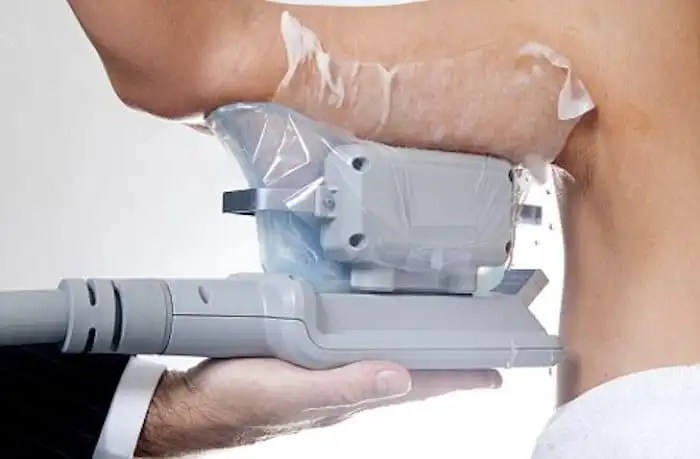 Picture of fat freezing Henley-In-Arden on the upper arms.