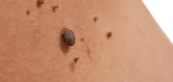 image of a skin tag Henley-In-Arden