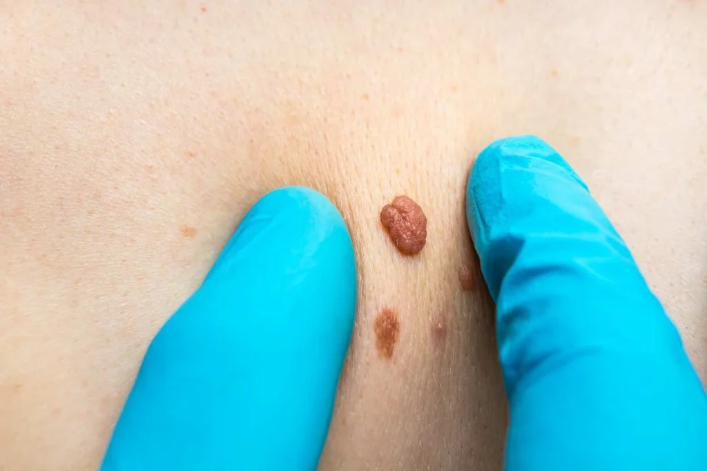 Consultant examining a skin tag Henley-In-Arden