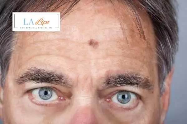 Solar Lentigo Removal Henley-In-Arden image of man with mark on his forehead