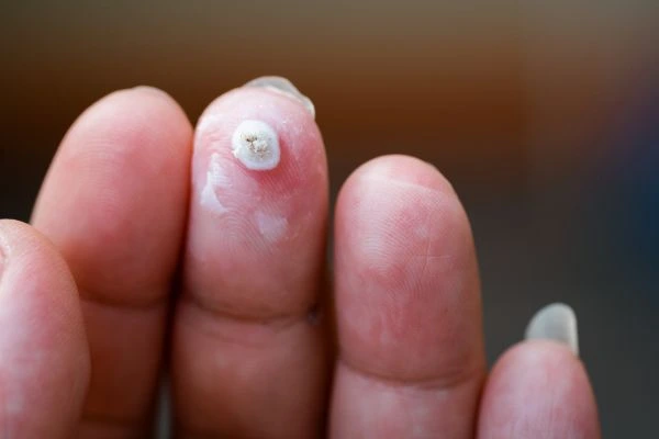 wart on person finger - cryotherapy to treat from LA LIPO Henley-In-Arden