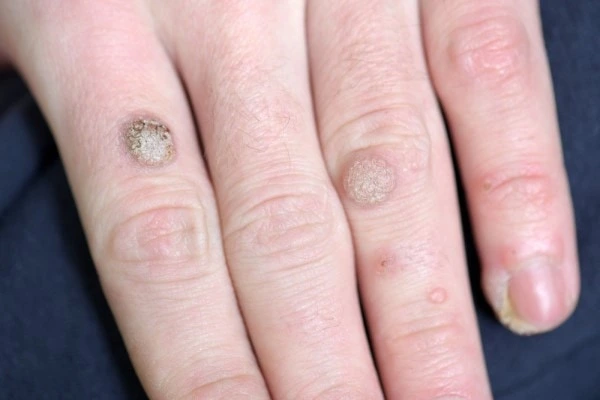 photo of warts on person hand - see wart removal Henley-In-Arden from LA LIPO
