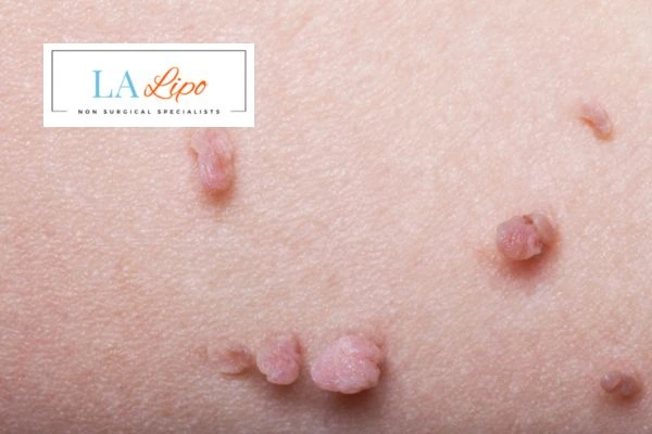 Does cryopen skin tag removal Henley-In-Arden hurt? Find out now call our team today!