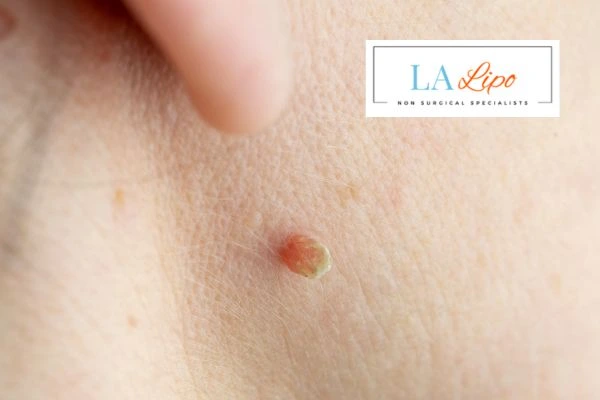 Book skin tag removal Henley-In-Arden today speak to our team now!