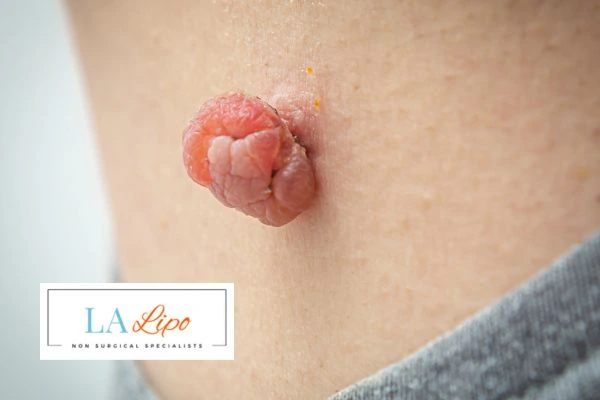 Interested in skin tag removal Henley-In-Arden? Concerned about the pain? Find out more today!