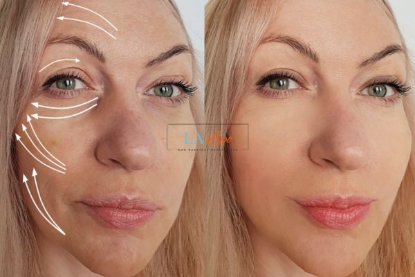 Morpheus 8 results Henley-In-Arden face lift.