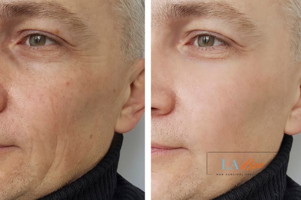See the amazing results of Morpheus8 Treatment Henley-In-Arden!