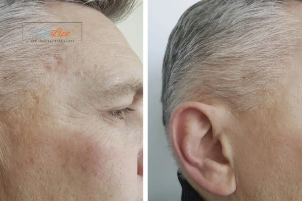 Mens Before & After Morpheus 8 Results Henley-In-Arden