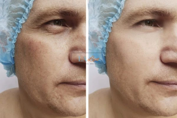 Before and after Morpheus 8 Results Henley-In-Arden