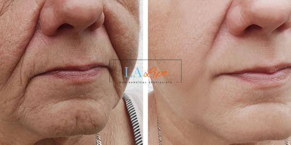 Older lady deeper wrinkle reduction - LA LIPO Morpheus 8 Results Henley-In-Arden