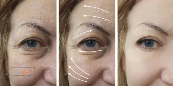 Amazing eye lift Morpheus 8 results Henley-In-Arden