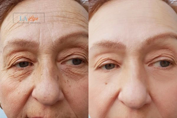 The powerful benefits of Morpheus8 Treatment Henley-In-Arden - Call Our team today!