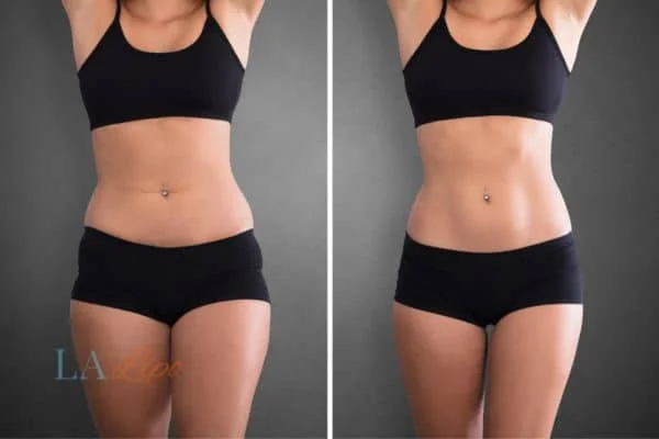 before and after results of non-surgical treatment to help a woman's body image and mental health Henley-In-Arden