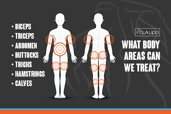 Diagram to show areas you can have LA-EMS Body Sculpting Treatment Henley-In-Arden