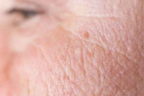 close up picture of a woman's face showing an age spot Henley-In-Arden