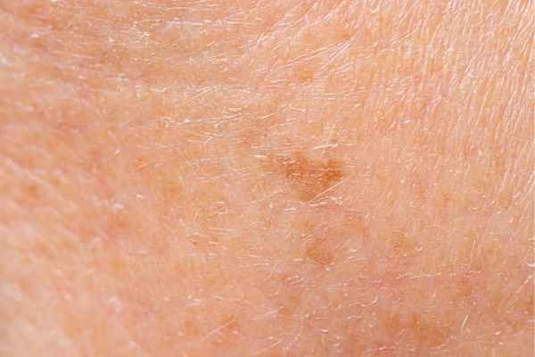 close up picture of age spots Henley-In-Arden