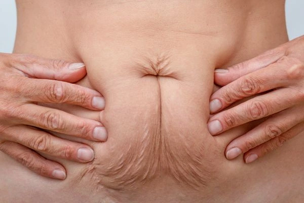 Image of a woman's stomach with loose skin - example of skin tightening Henley-In-Arden options