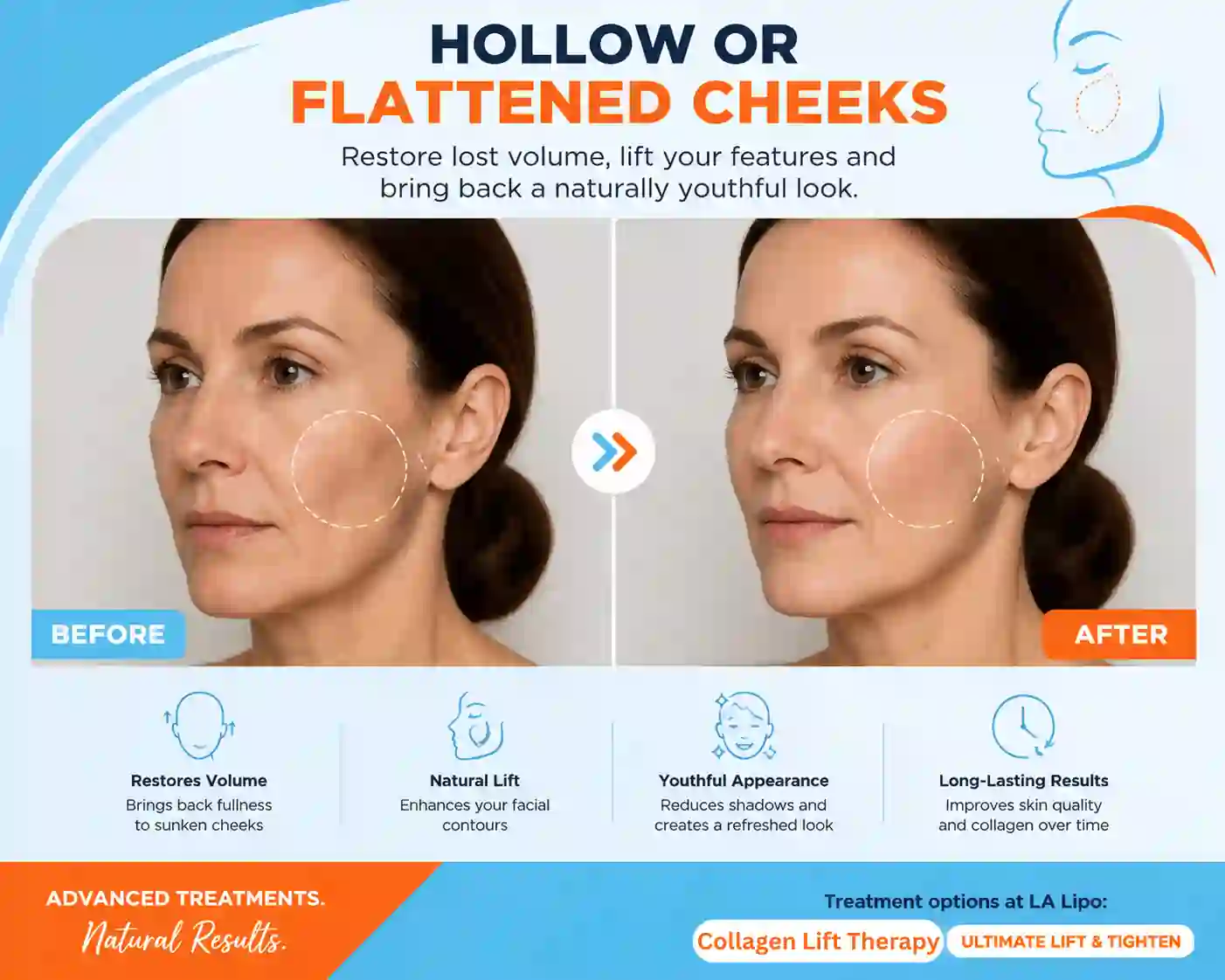 Sign #4: Hollow or Flattened Cheeks Henley-In-Arden